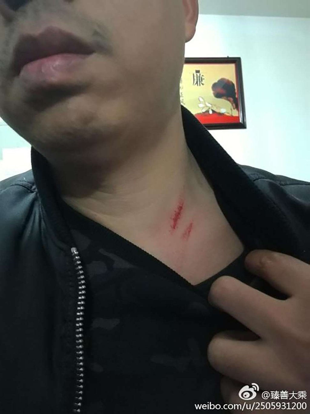 The man who says he was forced to have the operation shows injuries he claims he received during scuffles with officials. Photo: Handout