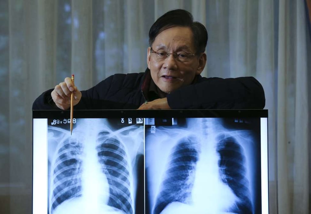 Dr Chan Shiu-lun shows an X-ray of a patent with extensive tuberculosis at the Hong Kong Tuberculosis Chest and Heart Diseases Association. Photo: Dickson Lee
