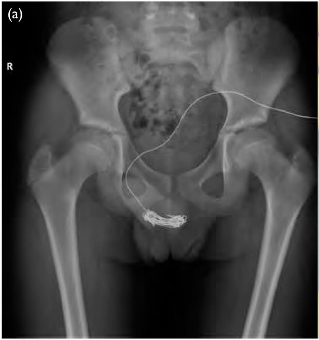 An X-ray showing the electrical wire inside the 12-year-old boy Photo: Hong Kong Medical Journal