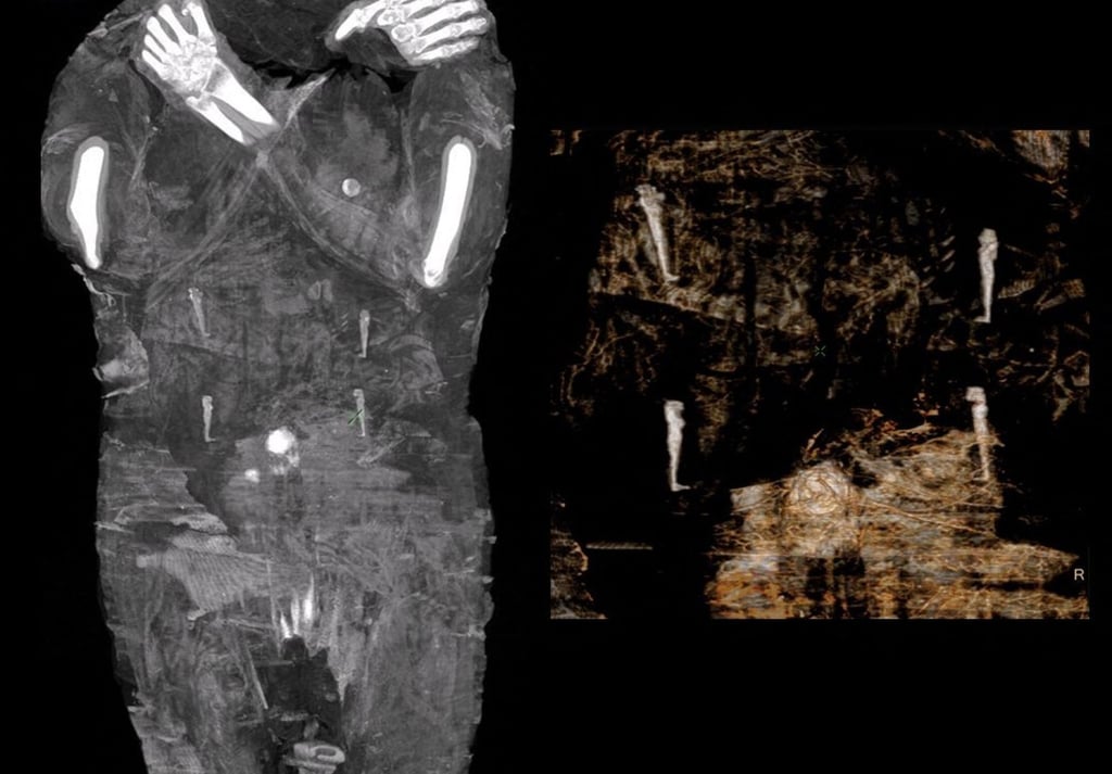 X-ray images of the pregnant Egyptian mummy were taken in 2015 at a medical centre in Otwock near Warsaw, Poland. Photo: Warsaw Mummy Project via AFP X-ray images of the pregnant Egyptian mummy were taken in 2015 at a medical centre in Otwock near Warsaw, Poland. Photo: Warsaw Mummy Project via AFP