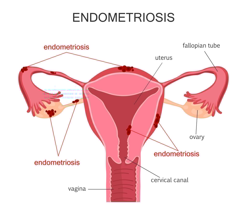 Endometriosis sometimes causes painful lesions and cysts that can result in infertility. Image: Getty Images/iStockphoto Endometriosis sometimes causes painful lesions and cysts that can result in infertility. Image: Getty Images/iStockphoto
