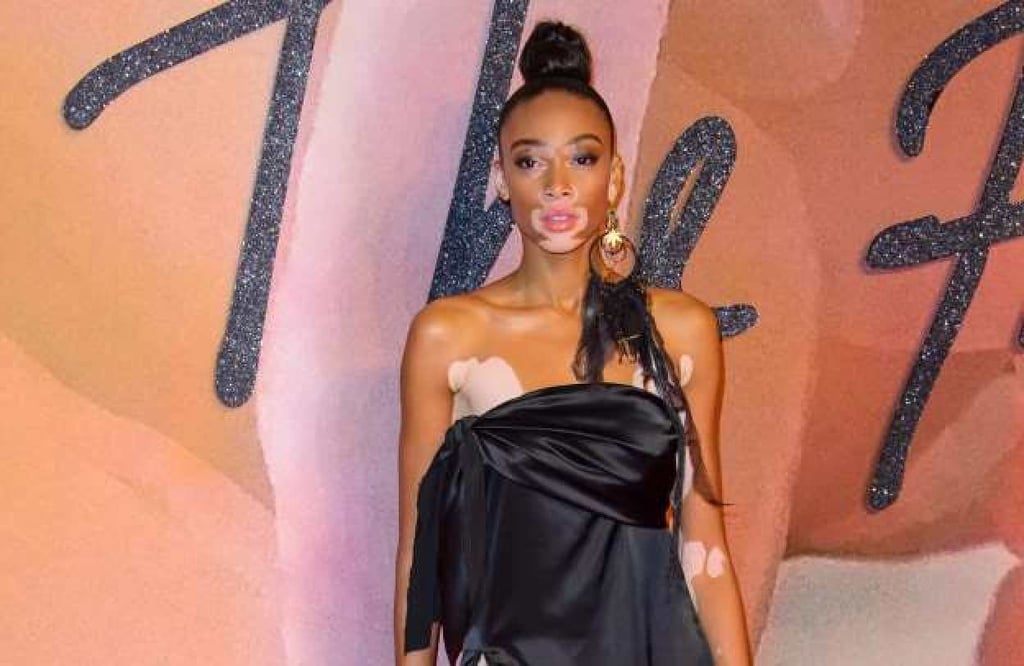Model Winnie Harlow suffers from vitiligo. Photo: Bang Showbiz Model Winnie Harlow suffers from vitiligo. Photo: Bang Showbiz