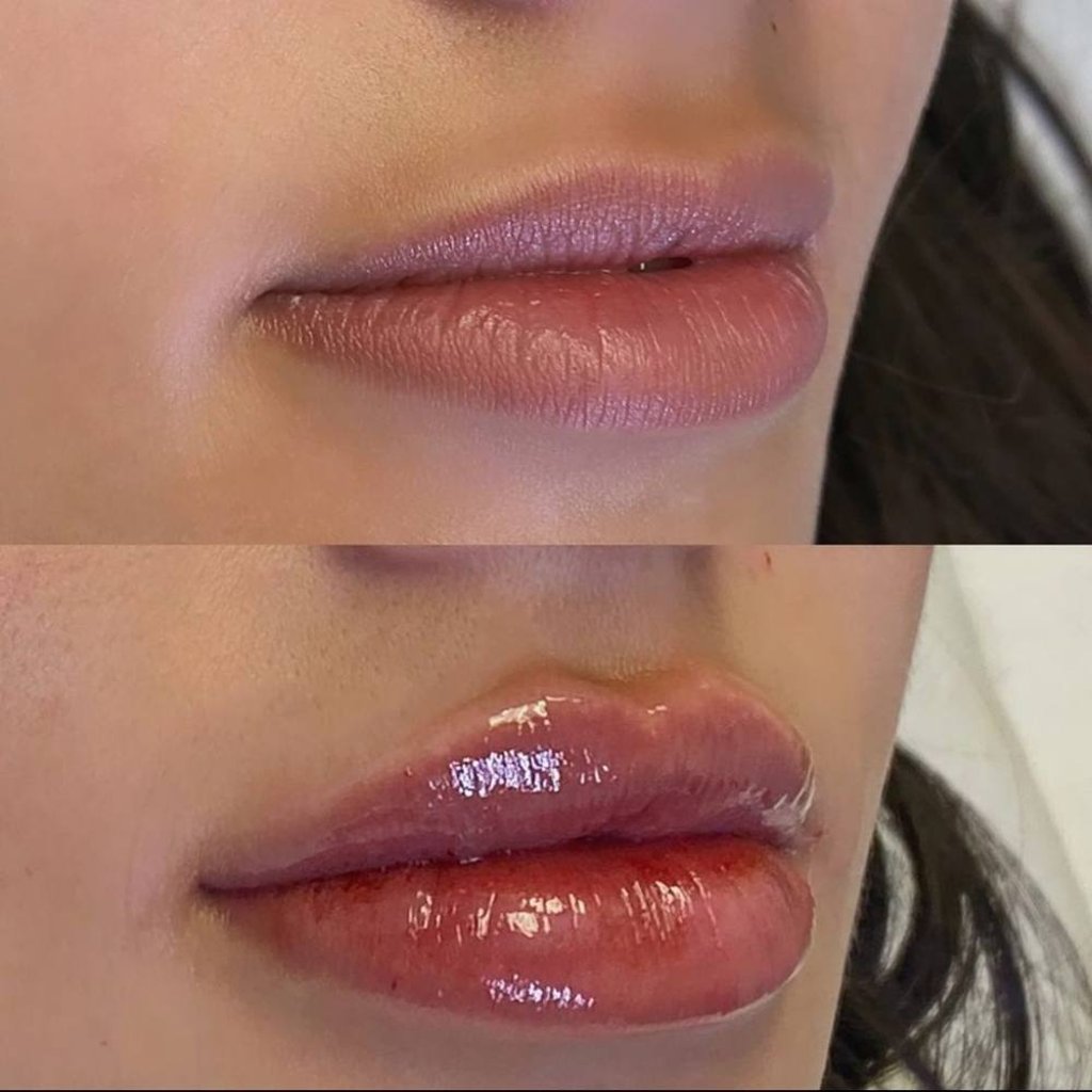 Before and after images of a patient who underwent lip implant surgery. Photo: Instagram Before and after images of a patient who underwent lip implant surgery. Photo: Instagram