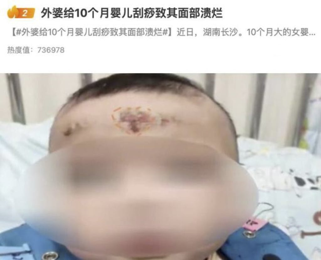The baby girl’s forehead seen in a photo taken after she was admitted to hospital. Photo Baidu The baby girl’s forehead seen in a photo taken after she was admitted to hospital. Photo Baidu