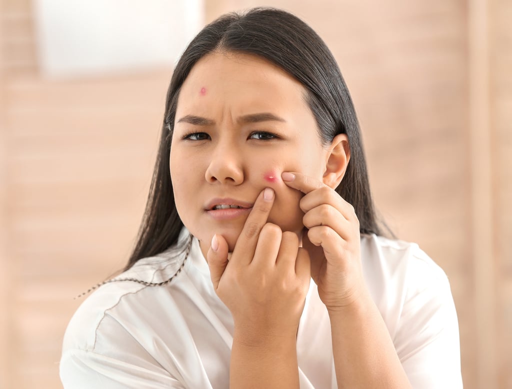 Popping pimples at home is generally frowned upon by dermatologists. Photo: Shutterstock