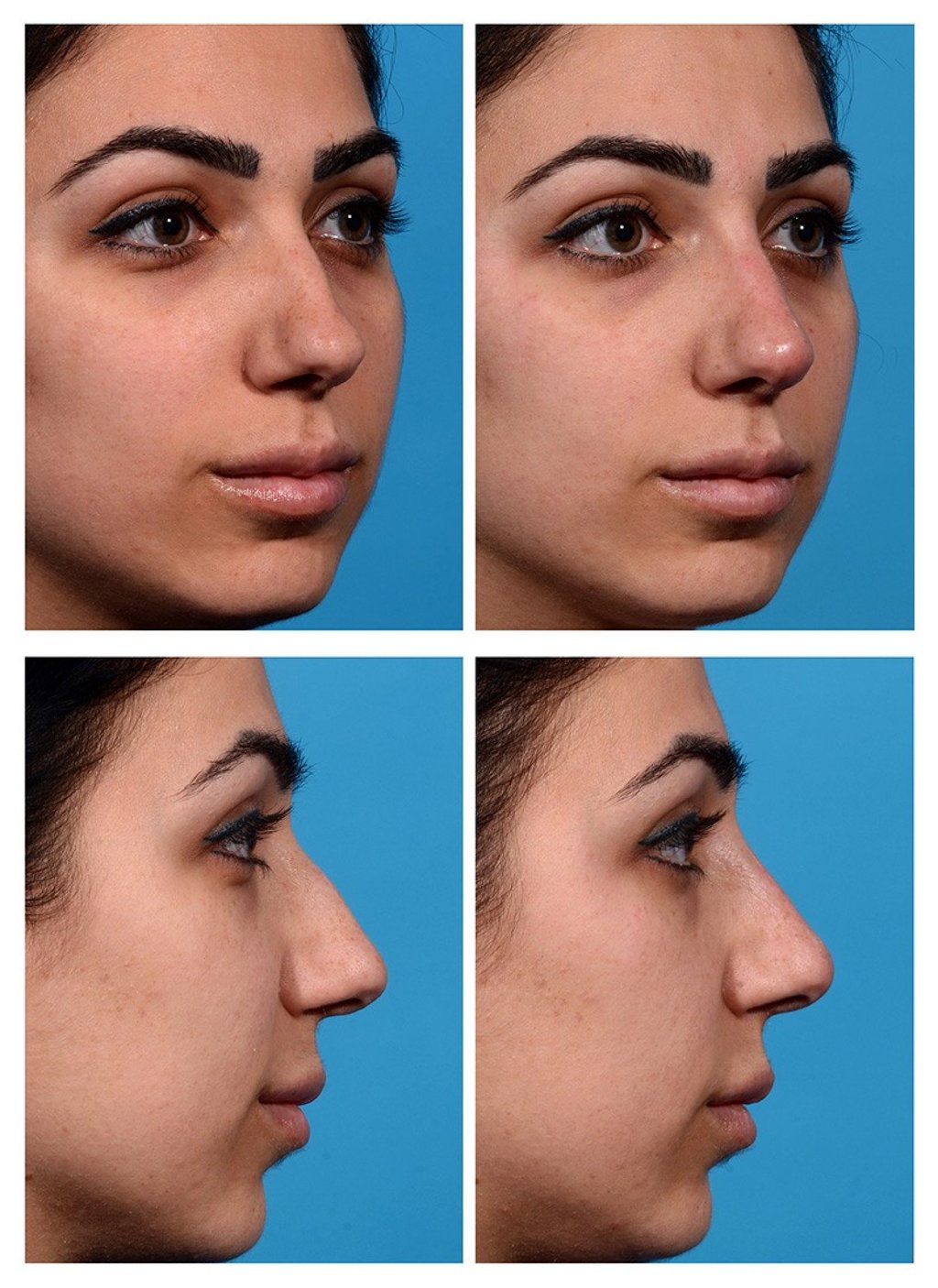 Before and after shots show the effects of liquid rhinoplasty. Before and after shots show the effects of liquid rhinoplasty.