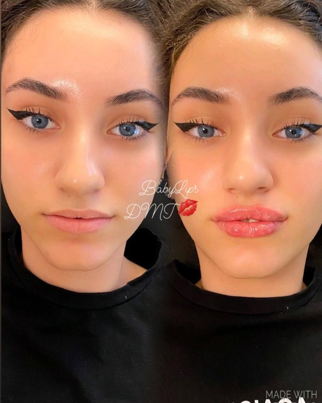 Botox & Hyaluron: My Before & After: My Biggest Beauty Secret Revealed! - llt1ros