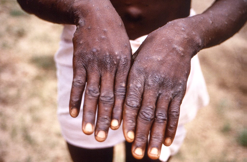 This 1997 image provided by the CDC shows a monkeypox patient who was displaying the characteristic rash. Photo: AP