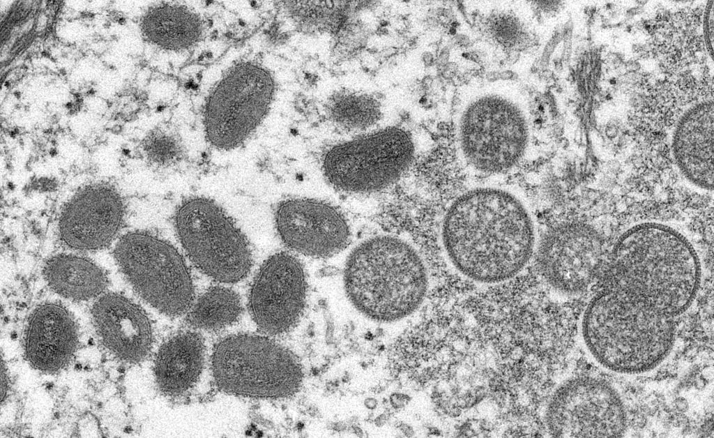 An electron microscopic image depicting a monkeypox virion. Photo: TNS An electron microscopic image depicting a monkeypox virion. Photo: TNS