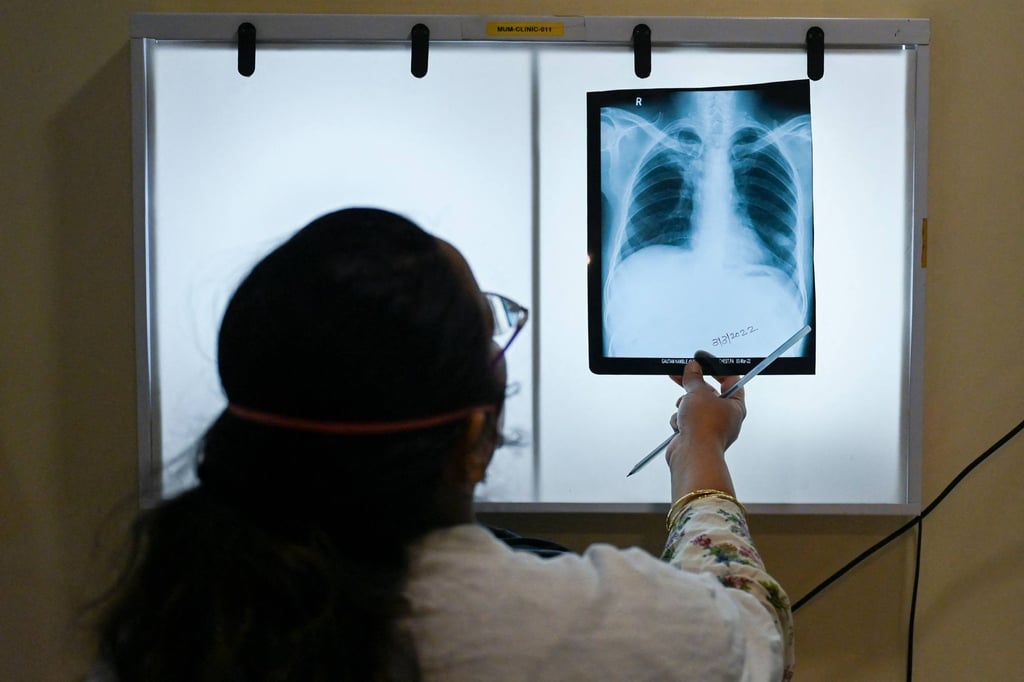 A doctor in Mumbai checks chest X-rays of a patient diagnosed with tuberculosis. An estimated 2.8 million Indians suffer from tuberculosis and around 500,000 were diagnosed with it in 2021. Photo: AFP