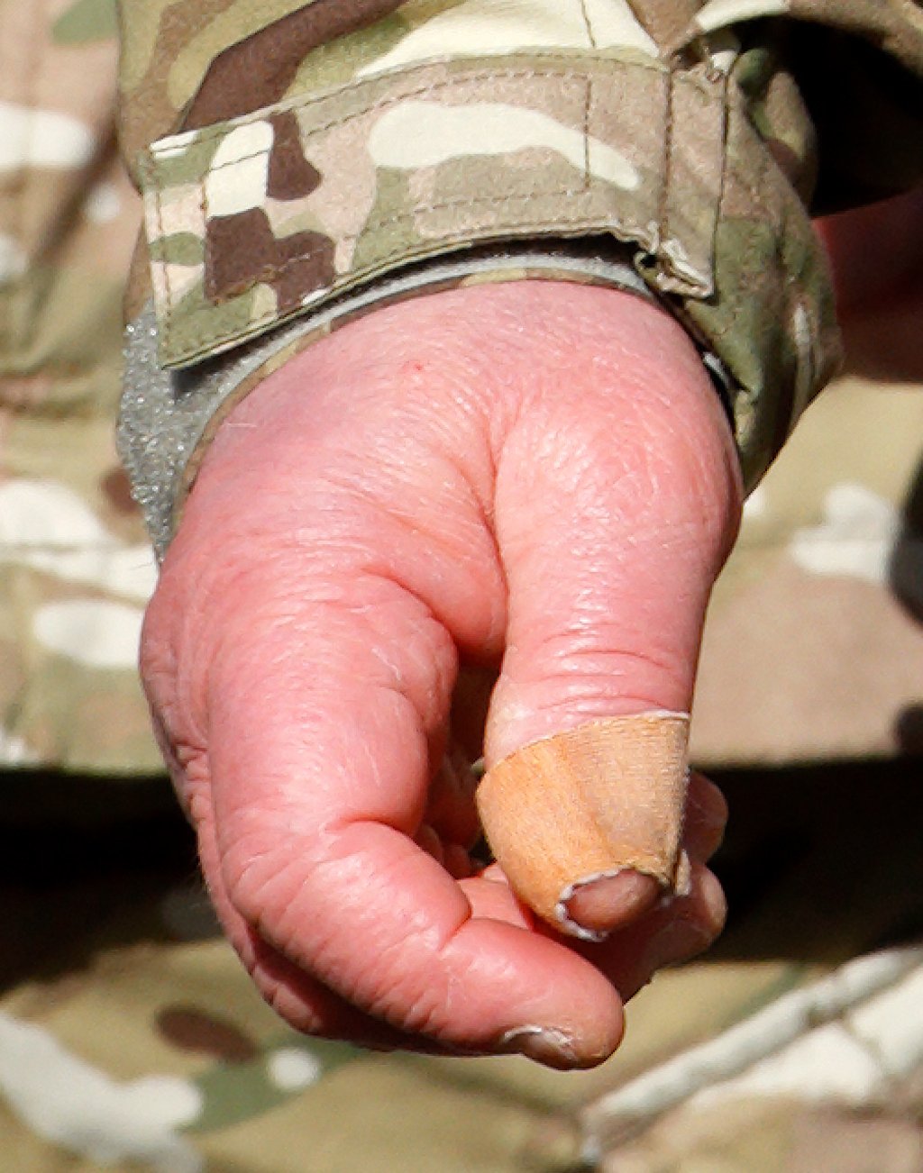 King Charles’ swollen hands during a 2019 ceremony in which the monarch decorated soldiers returning from Afghanistan. Photo: Getty Images King Charles’ swollen hands during a 2019 ceremony in which the monarch decorated soldiers returning from Afghanistan. Photo: Getty Images