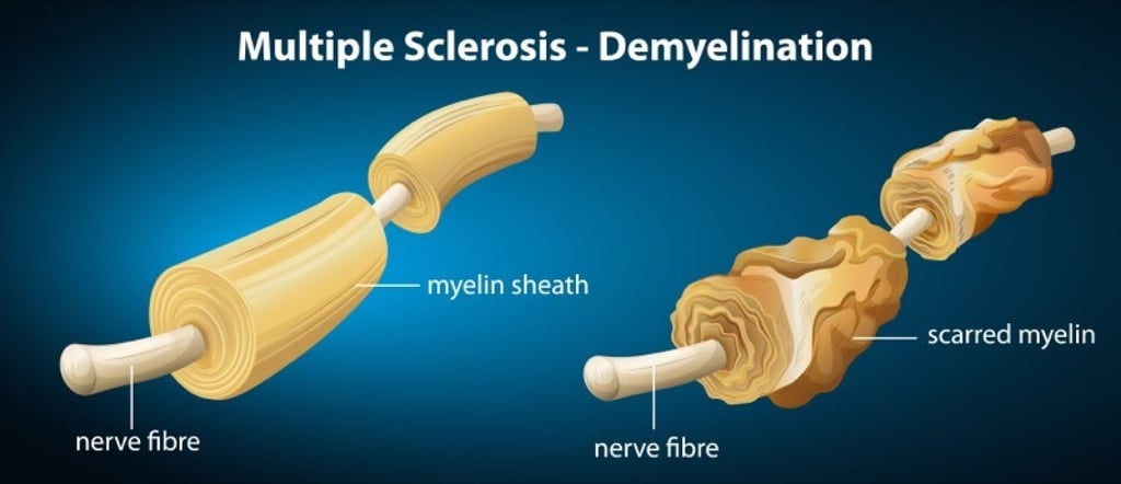 The effect of multiple sclerosis on a nerve’s myelin sheath. Photo: Shutterstock The effect of multiple sclerosis on a nerve’s myelin sheath. Photo: Shutterstock