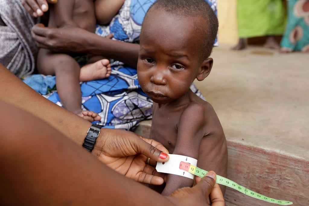 A malnourished child in Nigeria, where widespread hunger is in danger of turning into a “full-blown catastrophe”, the UN says. Photo: AP