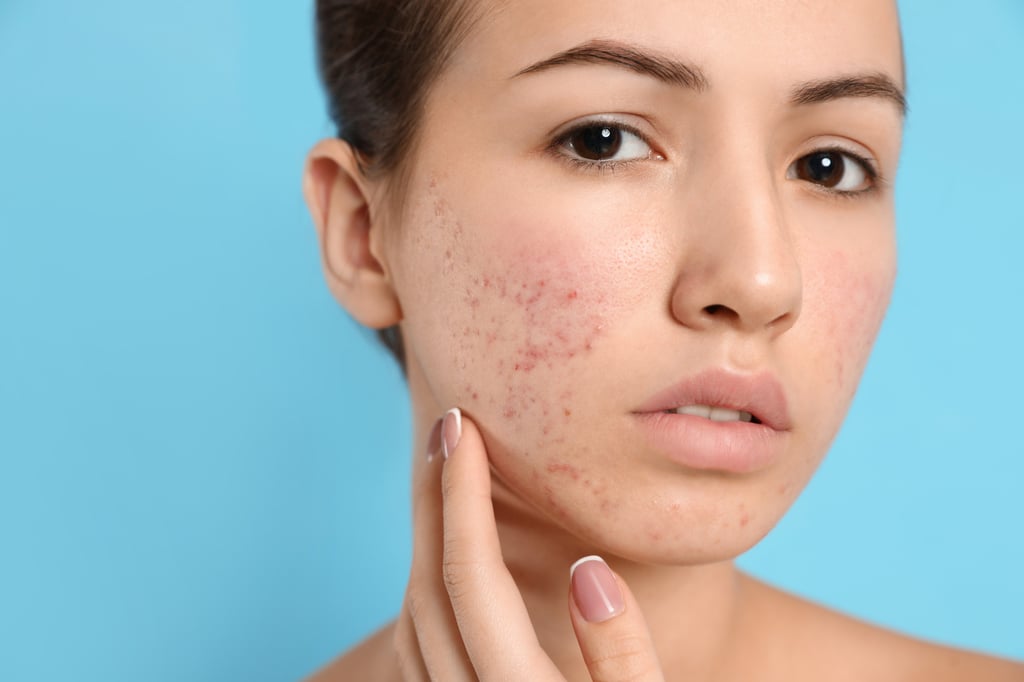 A common skincare myth is that oils clog the pores, leading to acne and other forms of inflammation. Photo: Shutterstock