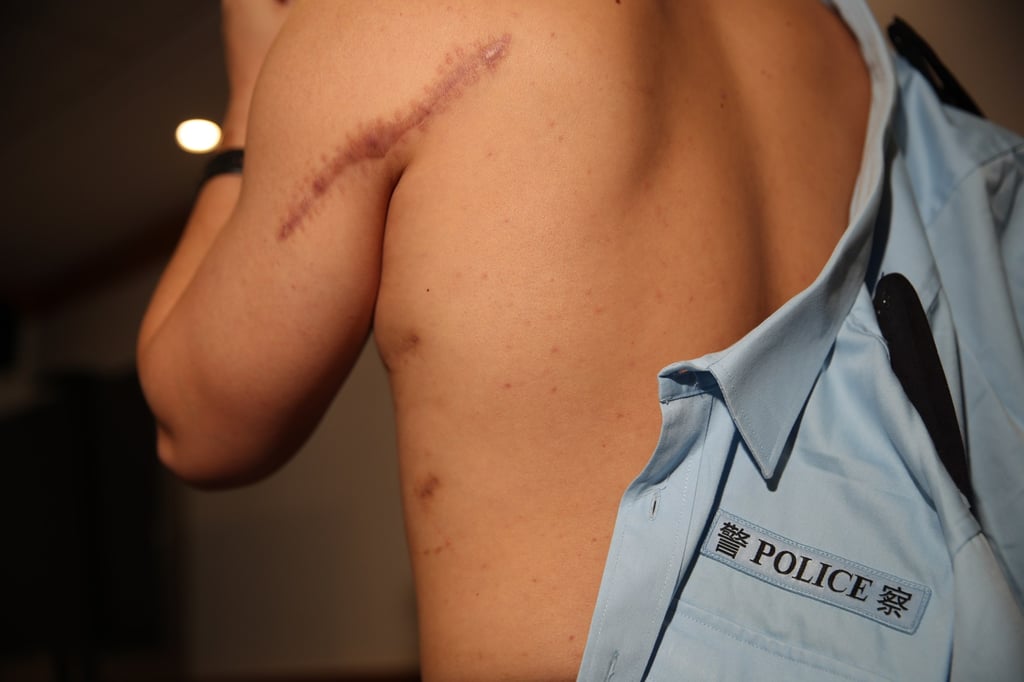 The injured police officer shows the scars left after he was the victim of a lone wolf attack outside a Causeway Bay department store two years ago. Photo: Edmond So The injured police officer shows the scars left after he was the victim of a lone wolf attack outside a Causeway Bay department store two years ago. Photo: Edmond So