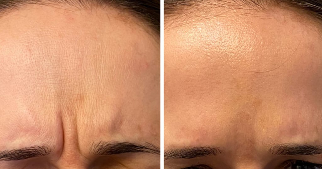 Daxxify before and after. Photo: Anna Avaliani MD Daxxify before and after. Photo: Anna Avaliani MD