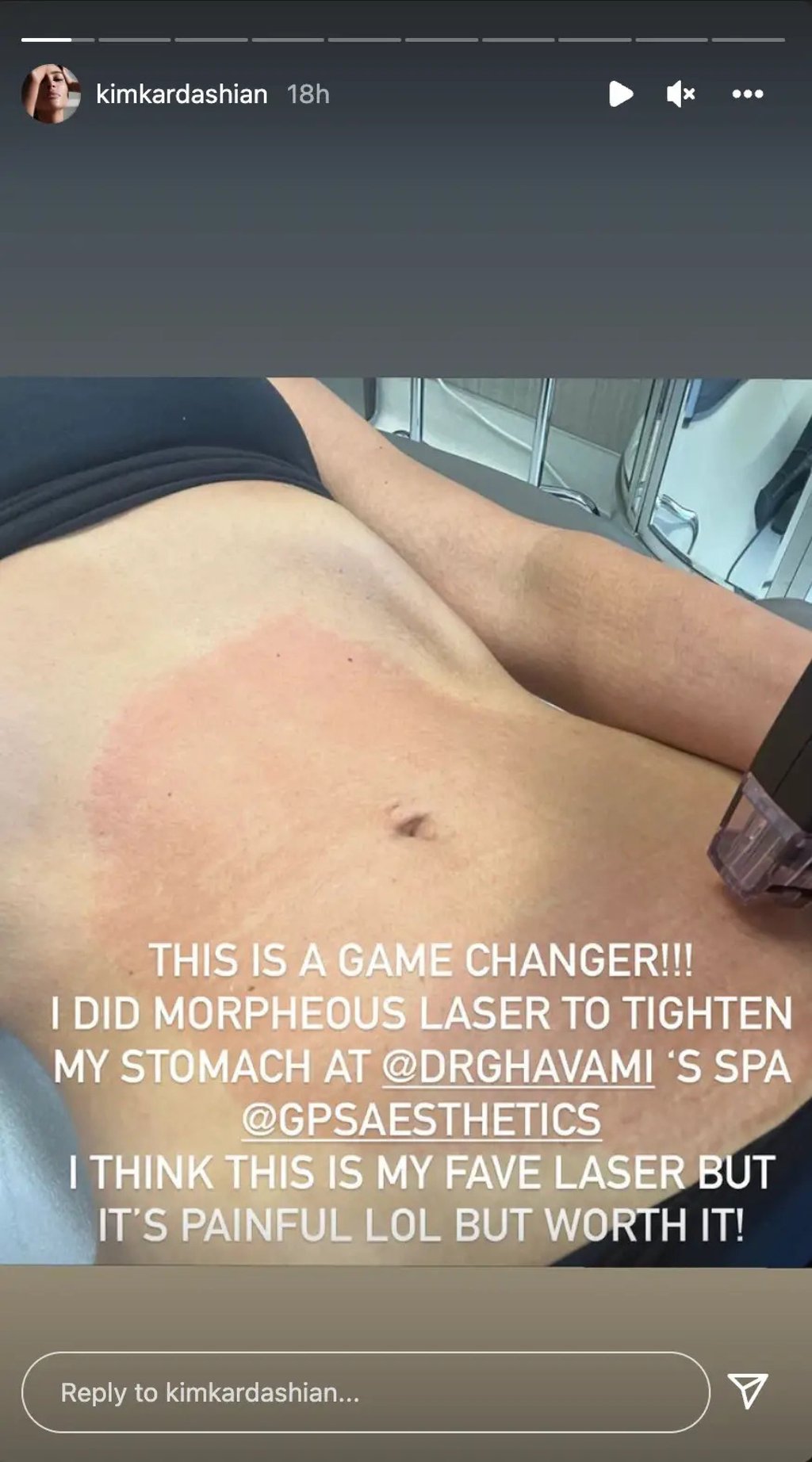 Morpheus8 can precisely target problem areas and even tighten the skin. Photo: Handout