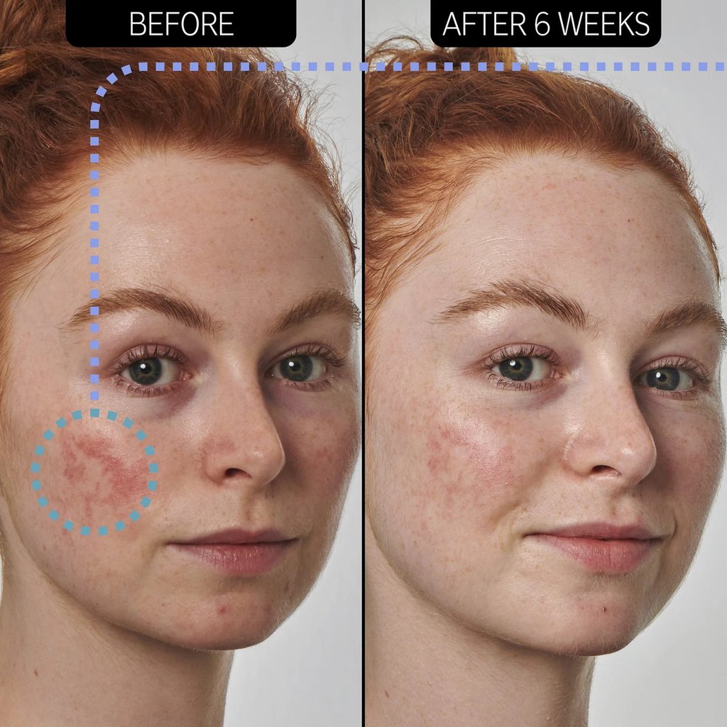 Explainer | What is azelaic acid and how do you use it? The skincare  ingredient alleviates beauty concerns like acne, dark spots, discolouration  and rosacea-related redness – but watch out for side