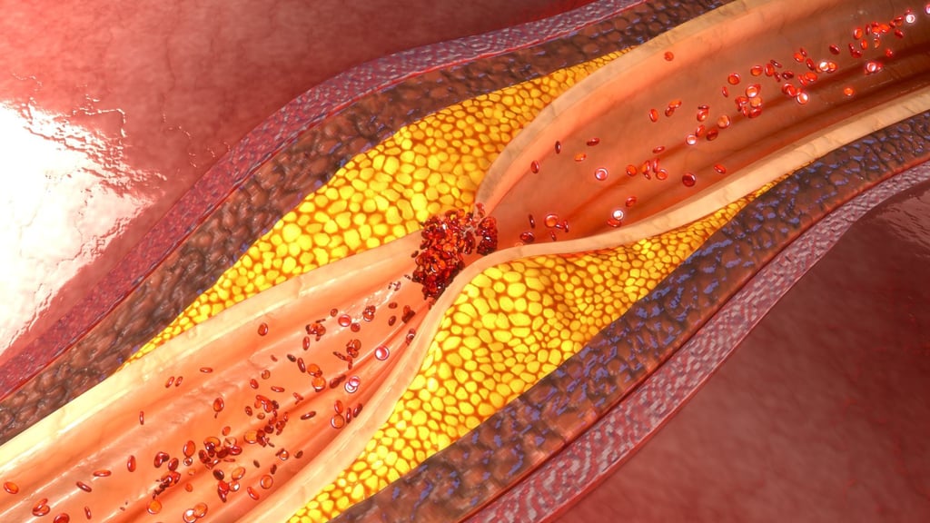 Statins, which may help stop the build-up of cholesterol in the coronary arteries (pictured here in yellow), may also help stop the build-up of cholesterol in the brain. Photo: Shutterstock Statins, which may help stop the build-up of cholesterol in the coronary arteries (pictured here in yellow), may also help stop the build-up of cholesterol in the brain. Photo: Shutterstock