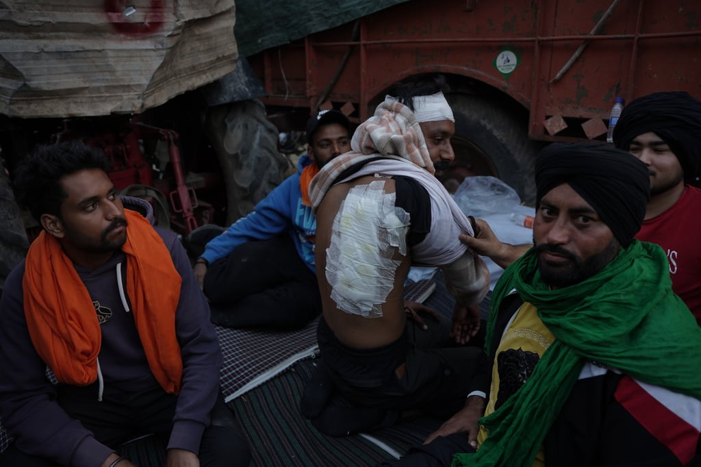 Lucky Ghrama, 28, was hit with pellets fired by the security forces. Photo: Bhat Burhan Lucky Ghrama, 28, was hit with pellets fired by the security forces. Photo: Bhat Burhan
