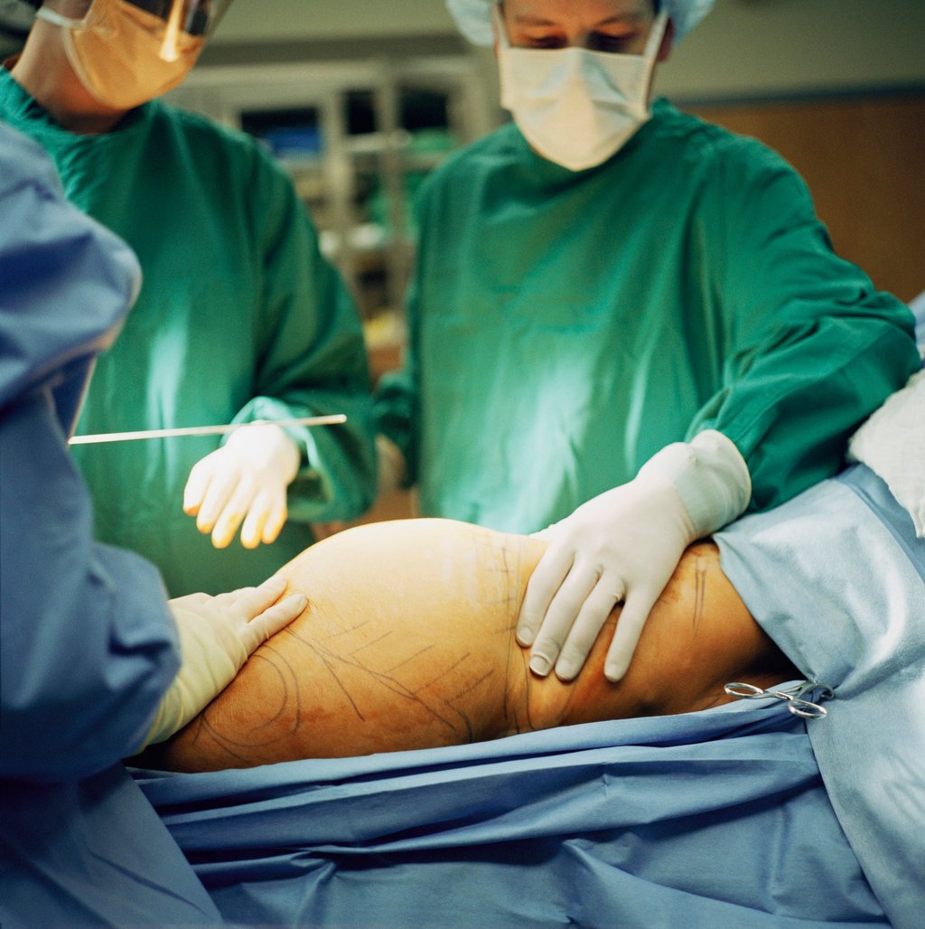 Liposuction surgery was first recorded in the 1920s, though the procedure as we understand it now developed in the late 20th century. Photo: Getty Images