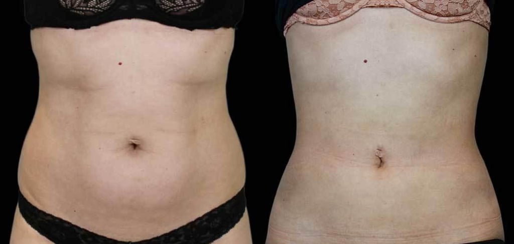 Liposuction may entail a lengthy recovery process for the patient. Photo: Wave Plastic Surgery