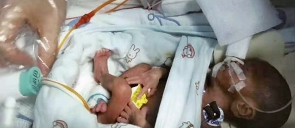 Little Xiyue was born after 25 weeks and required intensive care around the clock to stave off a range of potentially life-threatening conditions. Photo: 163.com Little Xiyue was born after 25 weeks and required intensive care around the clock to stave off a range of potentially life-threatening conditions. Photo: 163.com