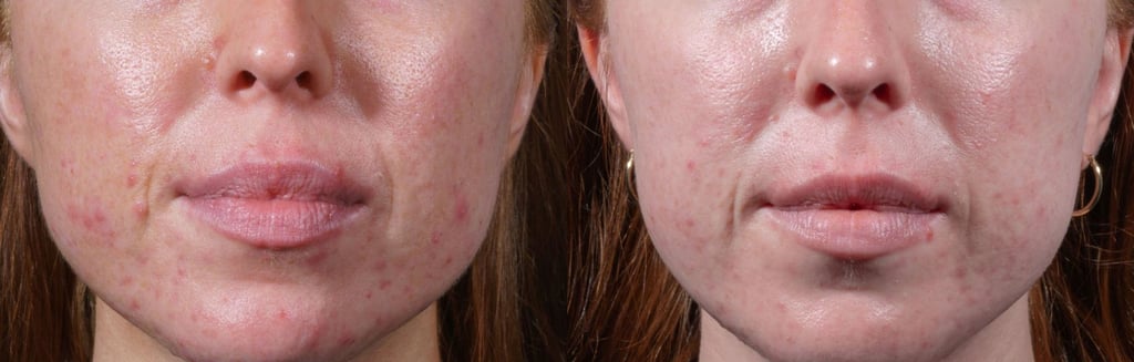 The anti-inflammatory benefits of exosome therapy are seen in this woman’s before and after pictures. Photo: Eternal SkinShine