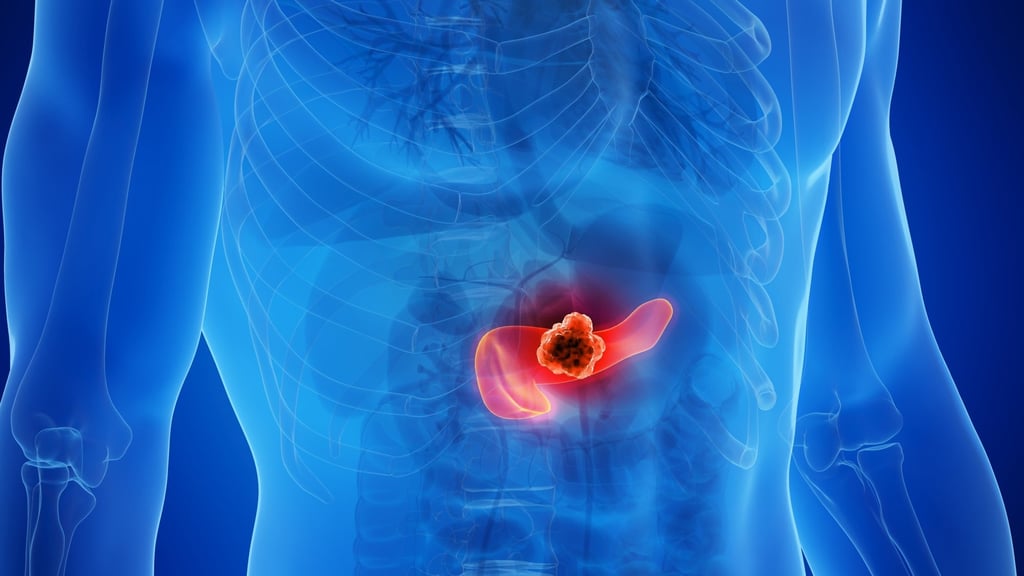 A new study shows how a keto diet might be used alongside a cancer therapy to eliminate pancreatic cancer, one of the deadliest common cancers and one of the hardest to detect. Photo: Shutterstock A new study shows how a keto diet might be used alongside a cancer therapy to eliminate pancreatic cancer, one of the deadliest common cancers and one of the hardest to detect. Photo: Shutterstock