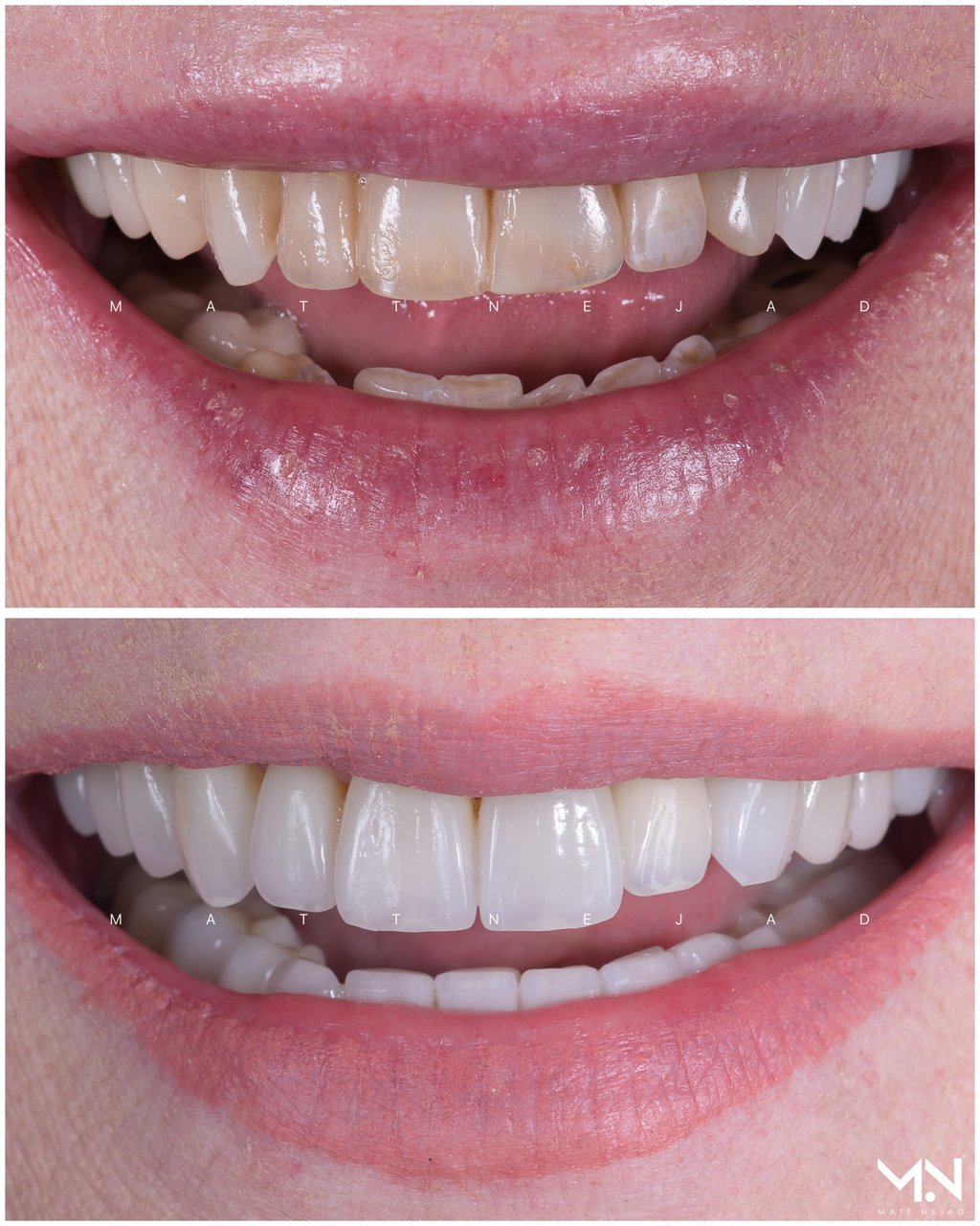 Before and after veneers. Photo: Handout