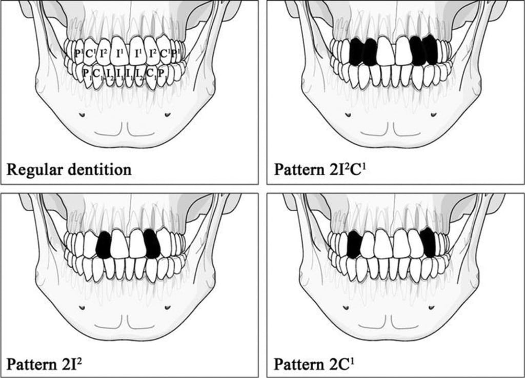 Illustration of regular dentition and common ablation patterns in ancient and contemporary populations in Taiwan. Black blocks indicate extracted teeth. Photo: Archaeological Research in Asia Illustration of regular dentition and common ablation patterns in ancient and contemporary populations in Taiwan. Black blocks indicate extracted teeth. Photo: Archaeological Research in Asia