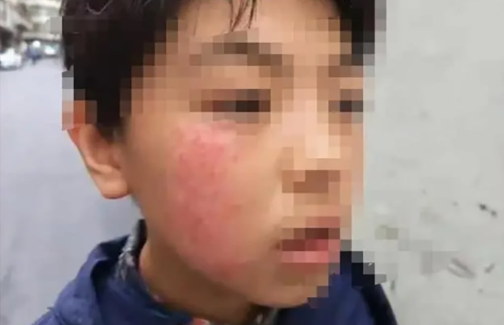 The boy’s face flushed bright red after the teacher slapped him three times on the right side, followed by a single slap on the left. Photo: Weibo