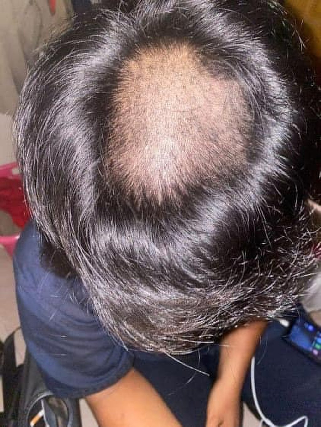 The teacher claimed that students’ hair lengths exceeded school regulations, so he shaved portions of the tops of their heads, leaving bald spots as punishment. Photo: Facebook The teacher claimed that students’ hair lengths exceeded school regulations, so he shaved portions of the tops of their heads, leaving bald spots as punishment. Photo: Facebook