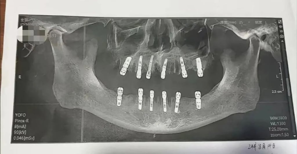 Tras las extracciones y los implantes, el hombre sufrió dolores constantes y murió de un ataque cardíaco 13 días después. Foto: Weixin