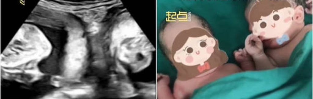 The condition of having a double ovary is quite rare, and it is even more unusual for a woman to successfully deliver a baby from each side. Photo: Douyin The condition of having a double ovary is quite rare, and it is even more unusual for a woman to successfully deliver a baby from each side. Photo: Douyin