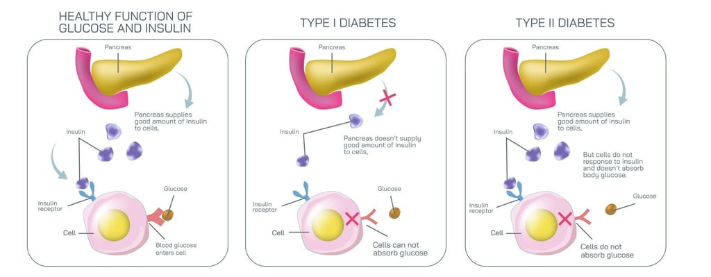 Type 1 diabetes develops when your immune system mistakenly attacks and destroys cells in your pancreas that make insulin, which is needed to help cells absorb glucose. Type 2 is caused by insulin resistance or insufficient insulin secretion. Photo: Shutterstock Type 1 diabetes develops when your immune system mistakenly attacks and destroys cells in your pancreas that make insulin, which is needed to help cells absorb glucose. Type 2 is caused by insulin resistance or insufficient insulin secretion. Photo: Shutterstock