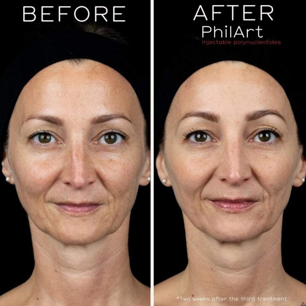 Before and after polynucleotide regenerative treatment. Photo: Cosmedics Skin Clinics Before and after polynucleotide regenerative treatment. Photo: Cosmedics Skin Clinics