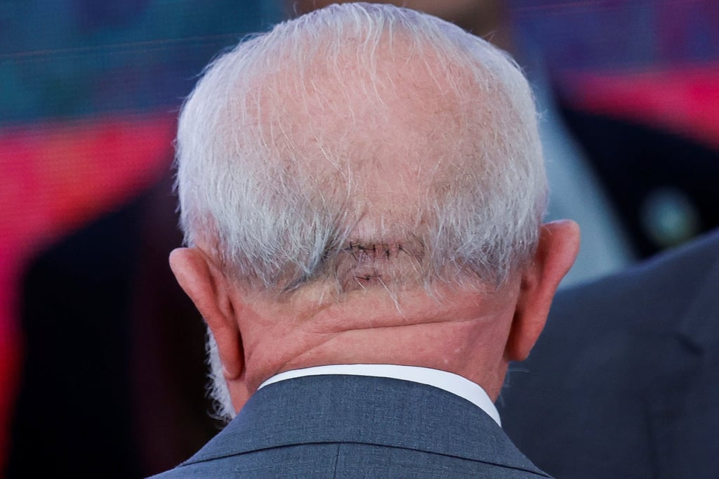 The head injury, as a result of a fall. Photo: Reuters