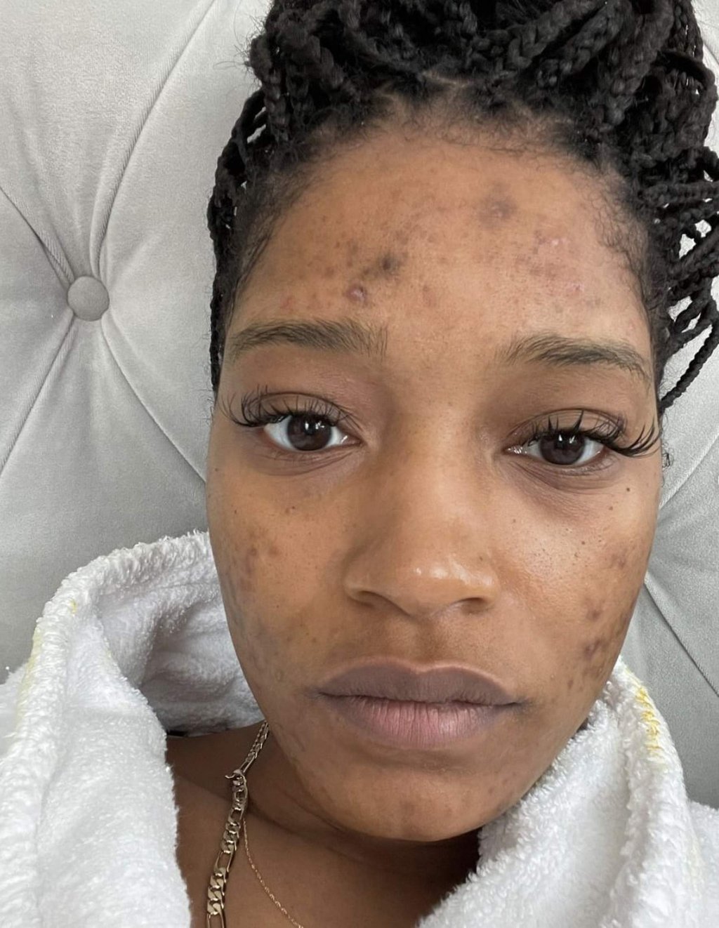 Actress and singer Keke Palmer has talked about how her PCOS led to acne. Photo: @keke/Instagram