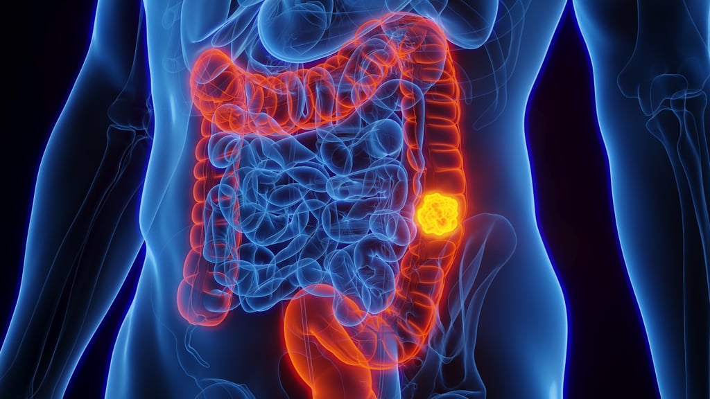 Colon cancer rates for people under the age of 50 are rising in many countries. Photo: Shutterstock Colon cancer rates for people under the age of 50 are rising in many countries. Photo: Shutterstock