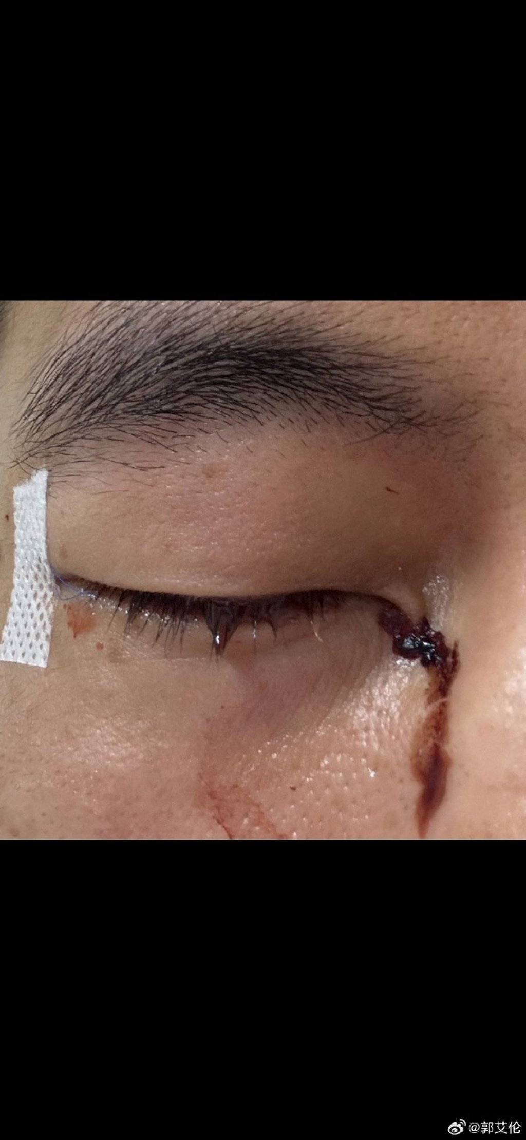 Guo Ailun’s eye injury required 40 stitches and could end his basketball career. Photo: Weibo/ 郭艾伦 Guo Ailun’s eye injury required 40 stitches and could end his basketball career. Photo: Weibo/ 郭艾伦