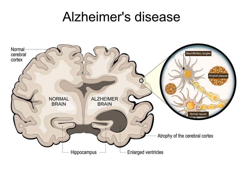 Some people exhibit amyloid plaques and tau tangles associated with Alzheimer’s but never develop dementia. Illustration: Shutterstock