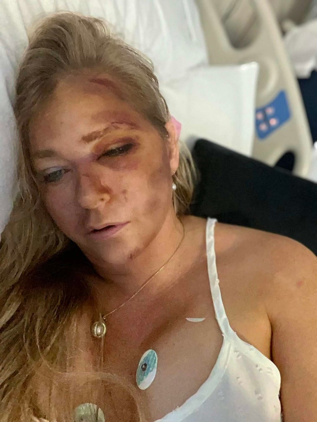 A photo Virginia Giuffre shared on social media on Monday after the car accident. Photo: @virginiarobertsrising11/Instagram