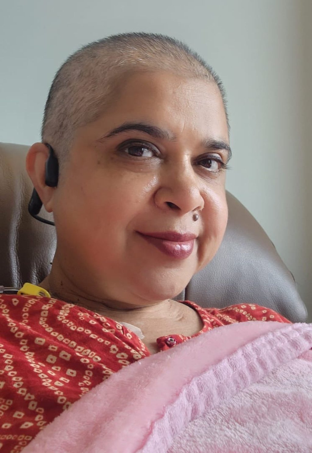 Suri with a shaved head in 2024 after losing hair from undergoing mantle radiation treatment. Photo: Aparna Suri Suri with a shaved head in 2024 after losing hair from undergoing mantle radiation treatment. Photo: Aparna Suri