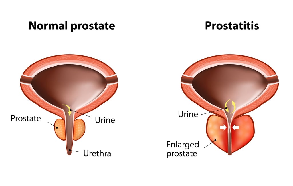 Prostate cancer is the fourth most common cancer worldwide and the second most common among men. Photo: Shutterstock Prostate cancer is the fourth most common cancer worldwide and the second most common among men. Photo: Shutterstock