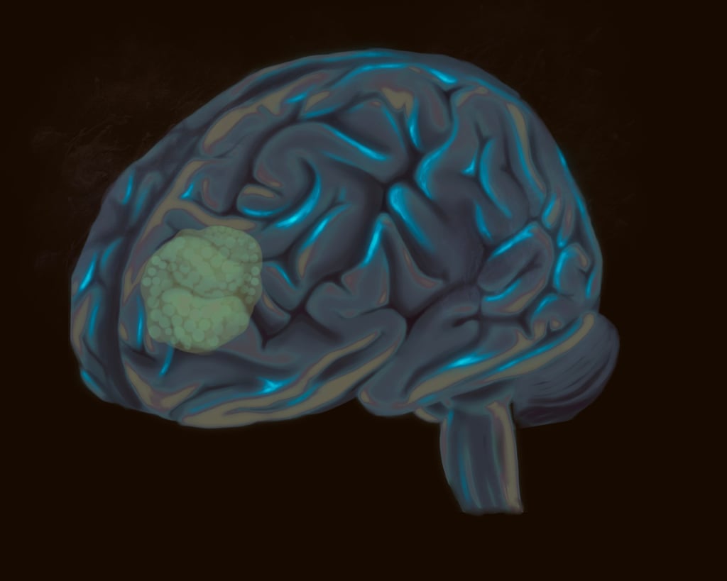 The new brain tumour test is a “game changer”, allowing suitable treatment to start almost immediately. Photo: Shutterstock The new brain tumour test is a “game changer”, allowing suitable treatment to start almost immediately. Photo: Shutterstock