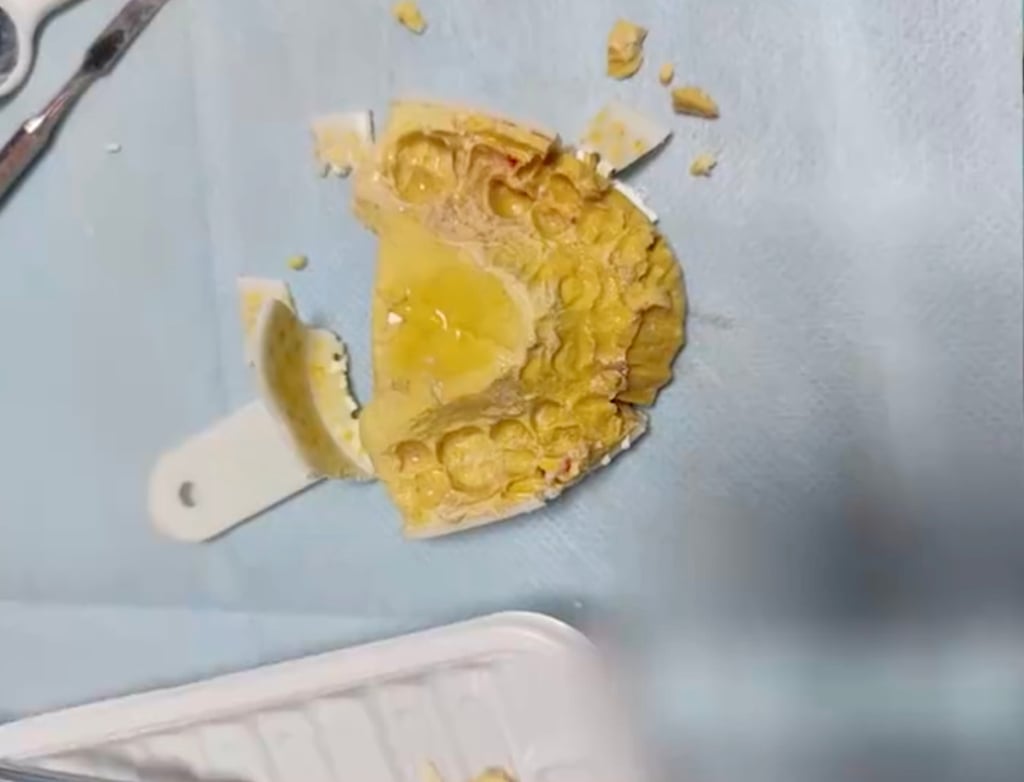 The broken home-made mould after doctors removed it from the woman’s mouth. Photo: ifeng The broken home-made mould after doctors removed it from the woman’s mouth. Photo: ifeng