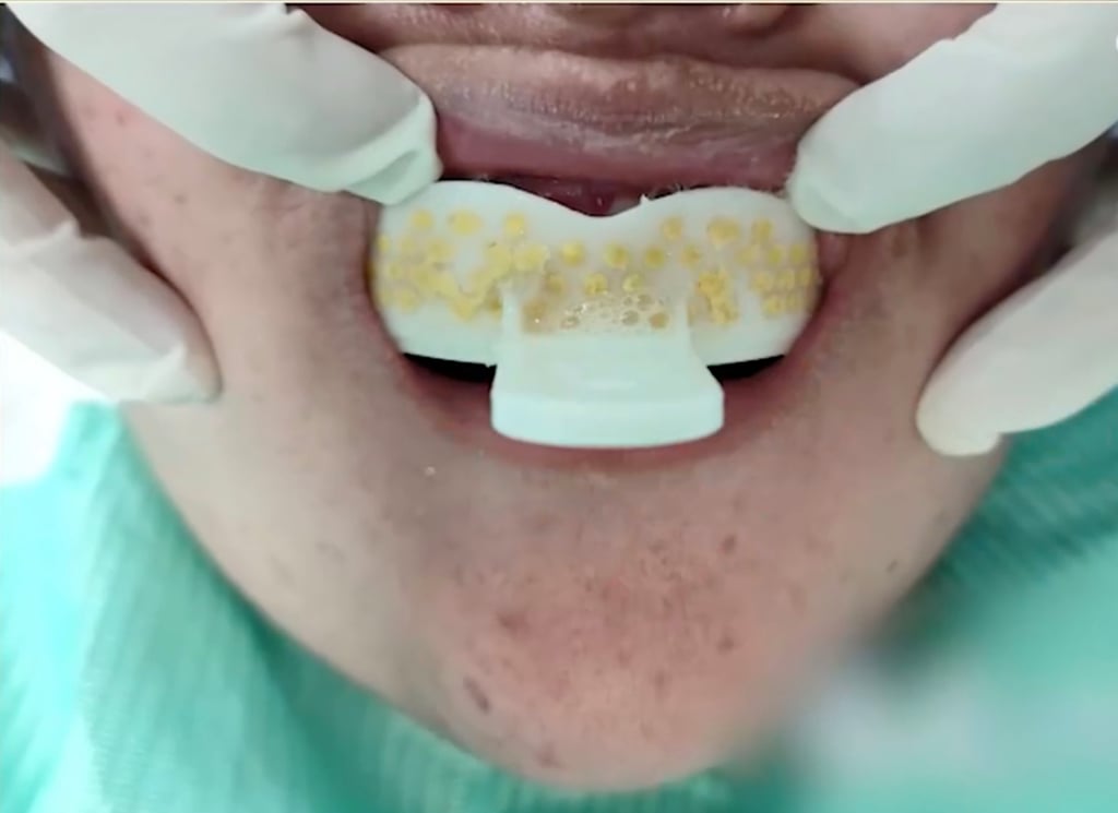 A close up photograph shows the wrongly applied mould stuck in the woman’s mouth Photo: ifeng A close up photograph shows the wrongly applied mould stuck in the woman’s mouth Photo: ifeng