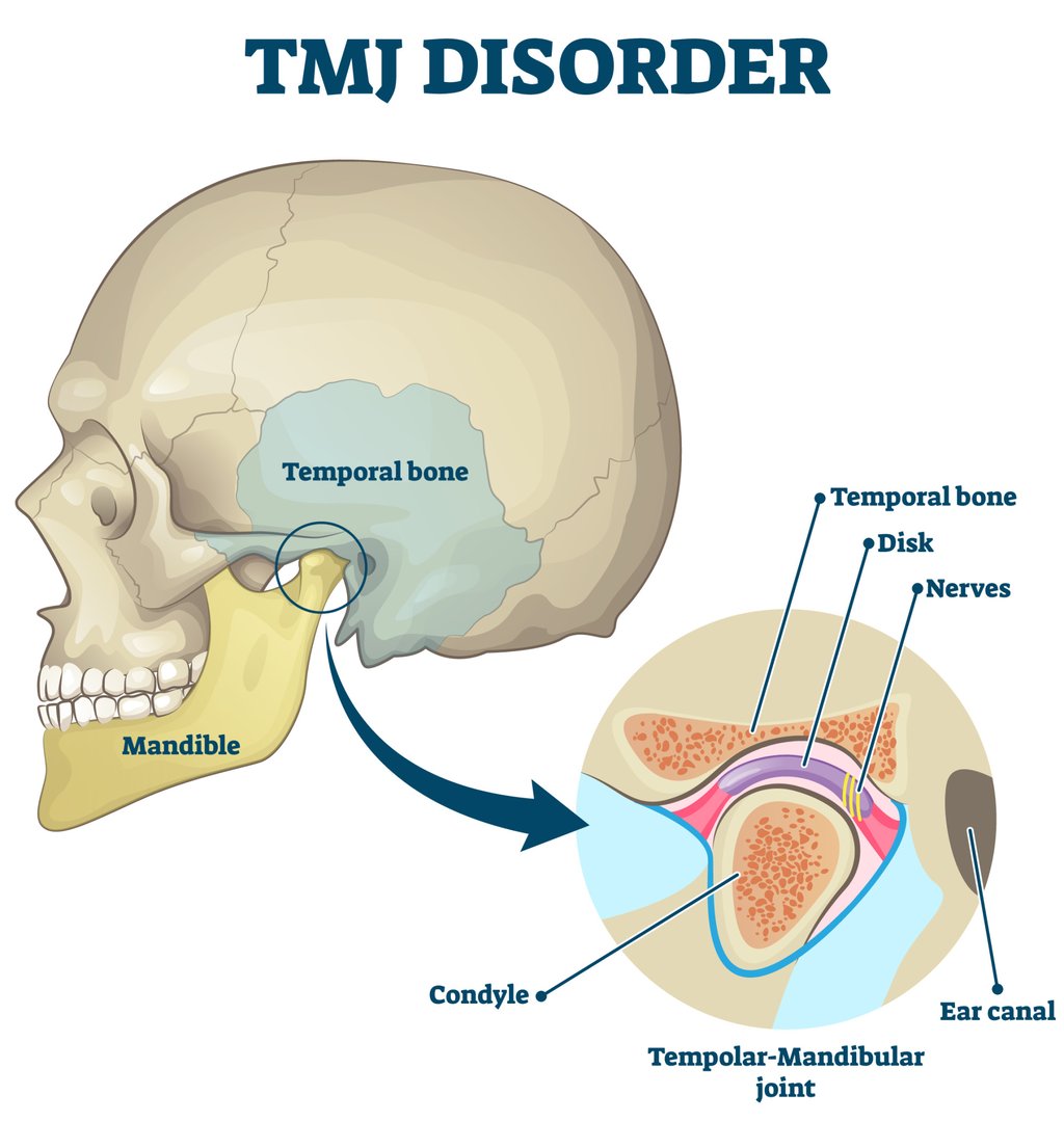 TMJ disorder refers to functional abnormalities and pain occurring in the jaw joint, surrounding ligaments, and the muscles involved in chewing. Illustration: Shutterstock TMJ disorder refers to functional abnormalities and pain occurring in the jaw joint, surrounding ligaments, and the muscles involved in chewing. Illustration: Shutterstock