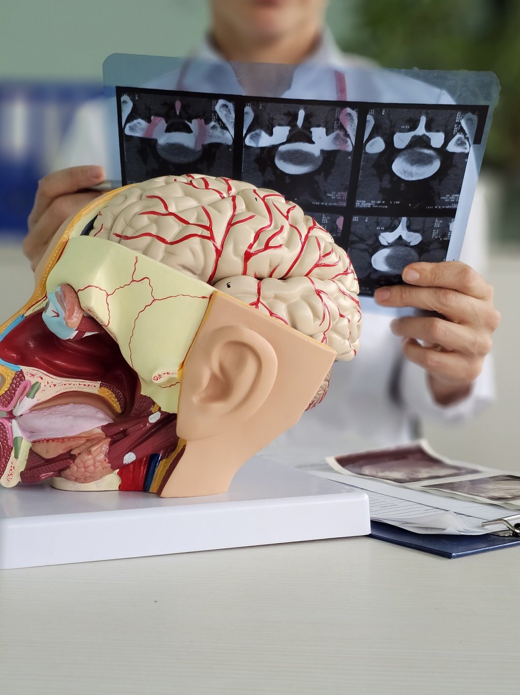 A neurologist who saw Buccola recognised the signs of a type of stroke known as venous sinus thrombosis. Photo: Shutterstock A neurologist who saw Buccola recognised the signs of a type of stroke known as venous sinus thrombosis. Photo: Shutterstock